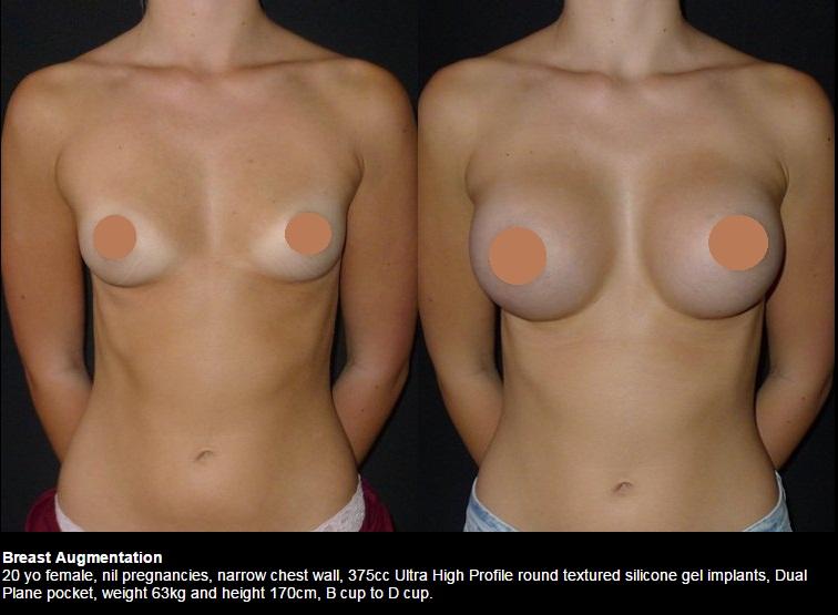 Breast Augmentation Breast Lift, Tummy Tuck, Rhinoplasty, Breast Augmentation, Labiaplasty, Plastic Surgeon, Cosmectic Surgeon